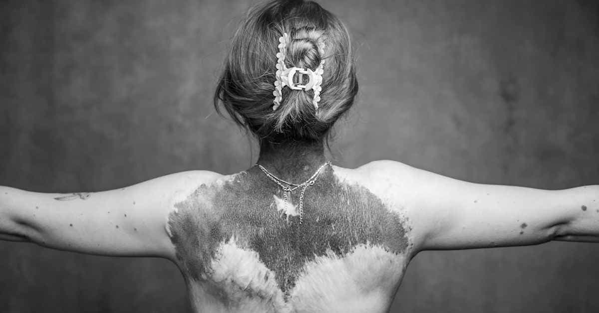 Medicinsk behandling av medfödd hudförändring CMN analyserad