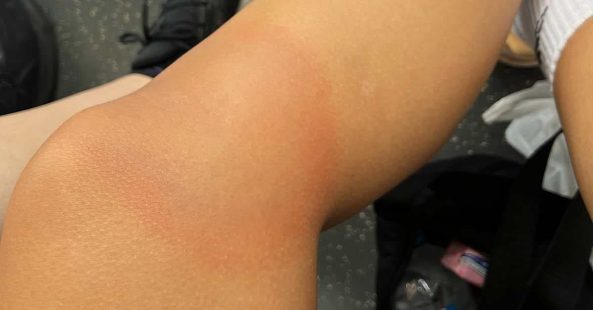 Rekordmånga borreliosfall i Finland kräver förstärkt folkhälsostrategi